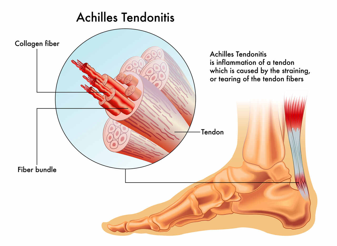 physiotherapy for achilles tendonitis