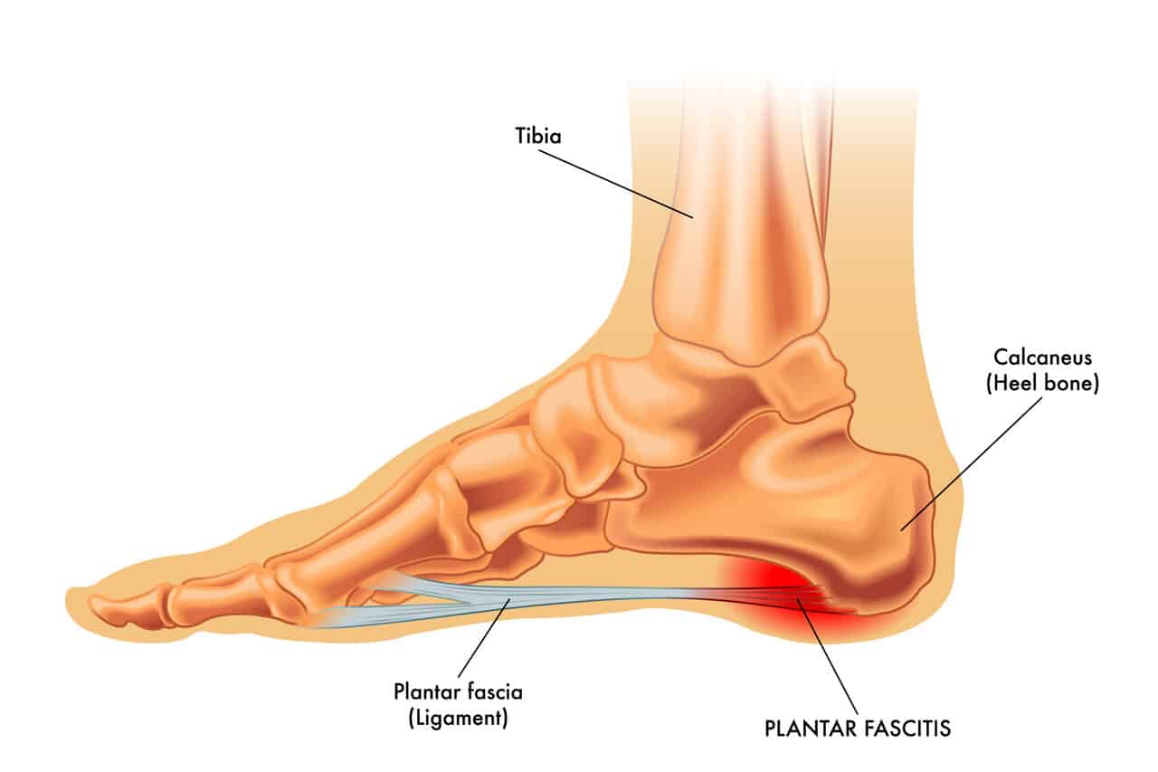 physiotherapy for plantar fasciitis